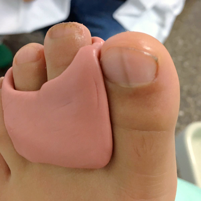 ortesi digitale in silicone del secondo e terzo dito